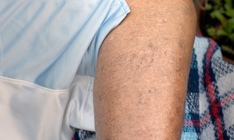 How Does Laser Vein Removal Work on Spider Veins?