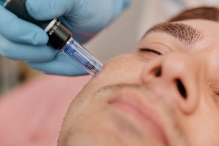What Types of Microneedling are Available?